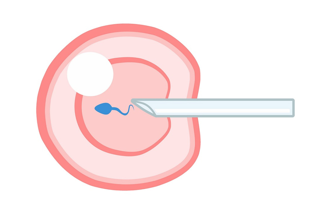 Understanding IVF Cycles