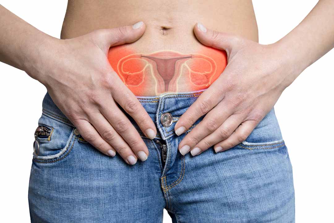 What is Ovarian Hyperstimulation Syndrome (OHSS)?