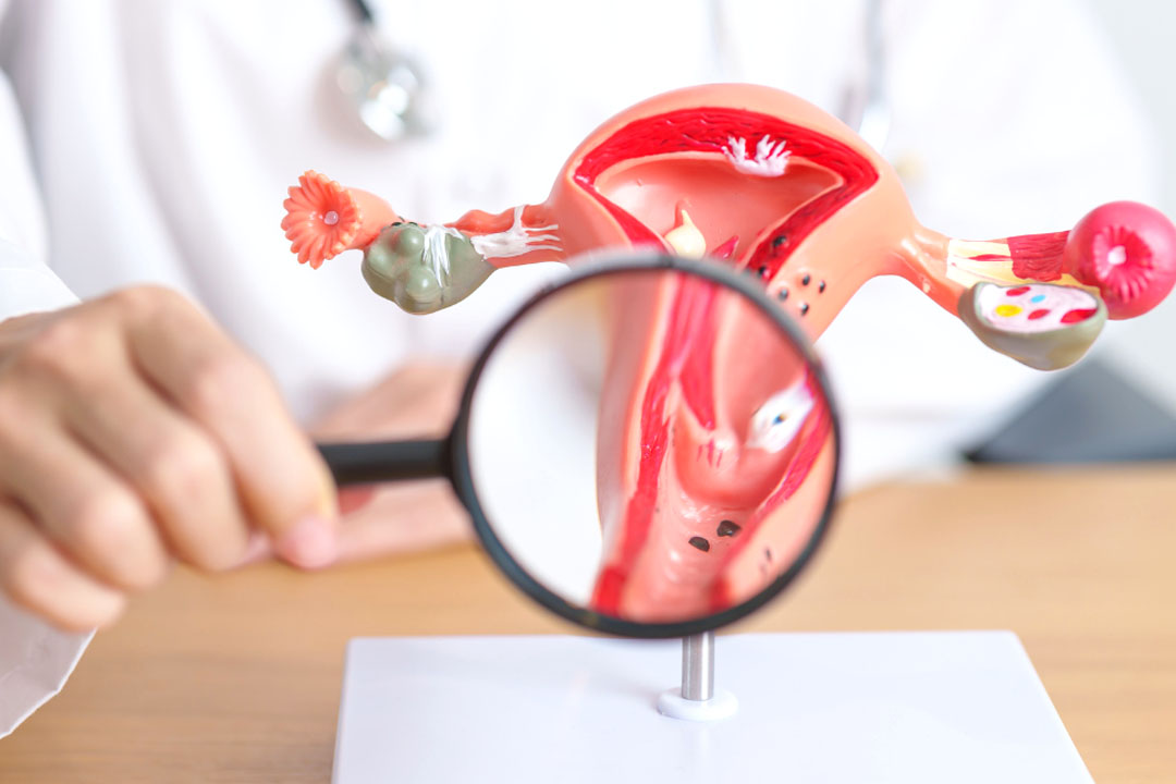 Which Size of Fibroid is Dangerous?