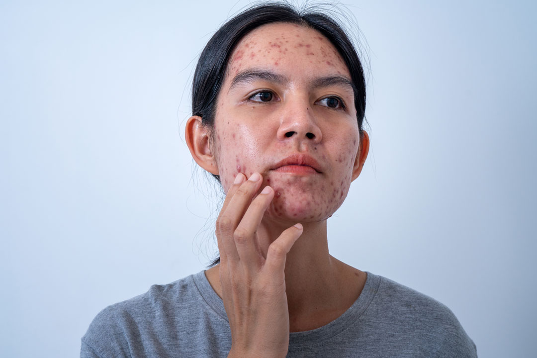 PCOS Acne vs Regular Acne