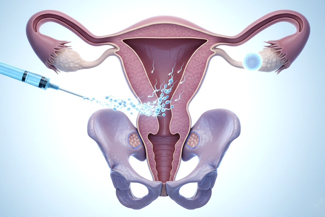 How Long Does It Take to Get Pregnant with IUI?