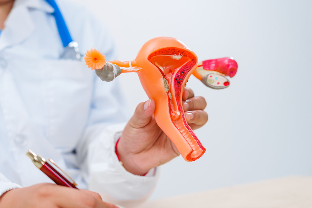 What Are Bilateral Polycystic Ovaries? Symptoms & Causes