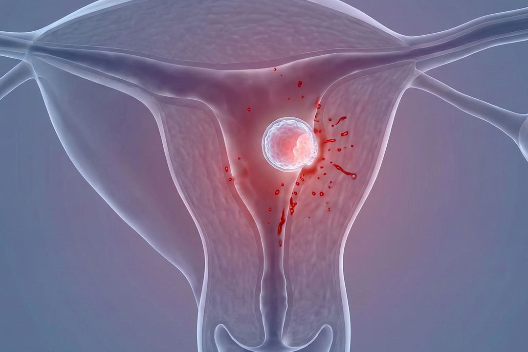 What Is Implantation Bleeding? Signs & Timing
