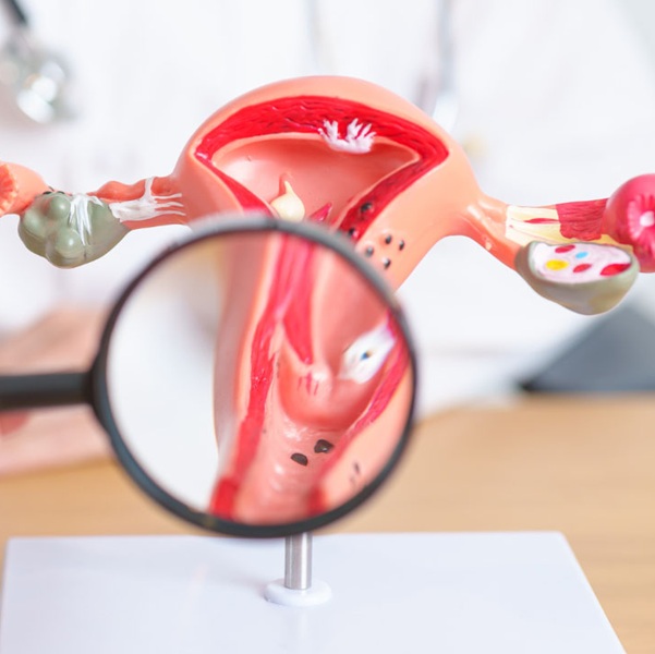 Choosing the Right Uterine Fibroid Treatment Center